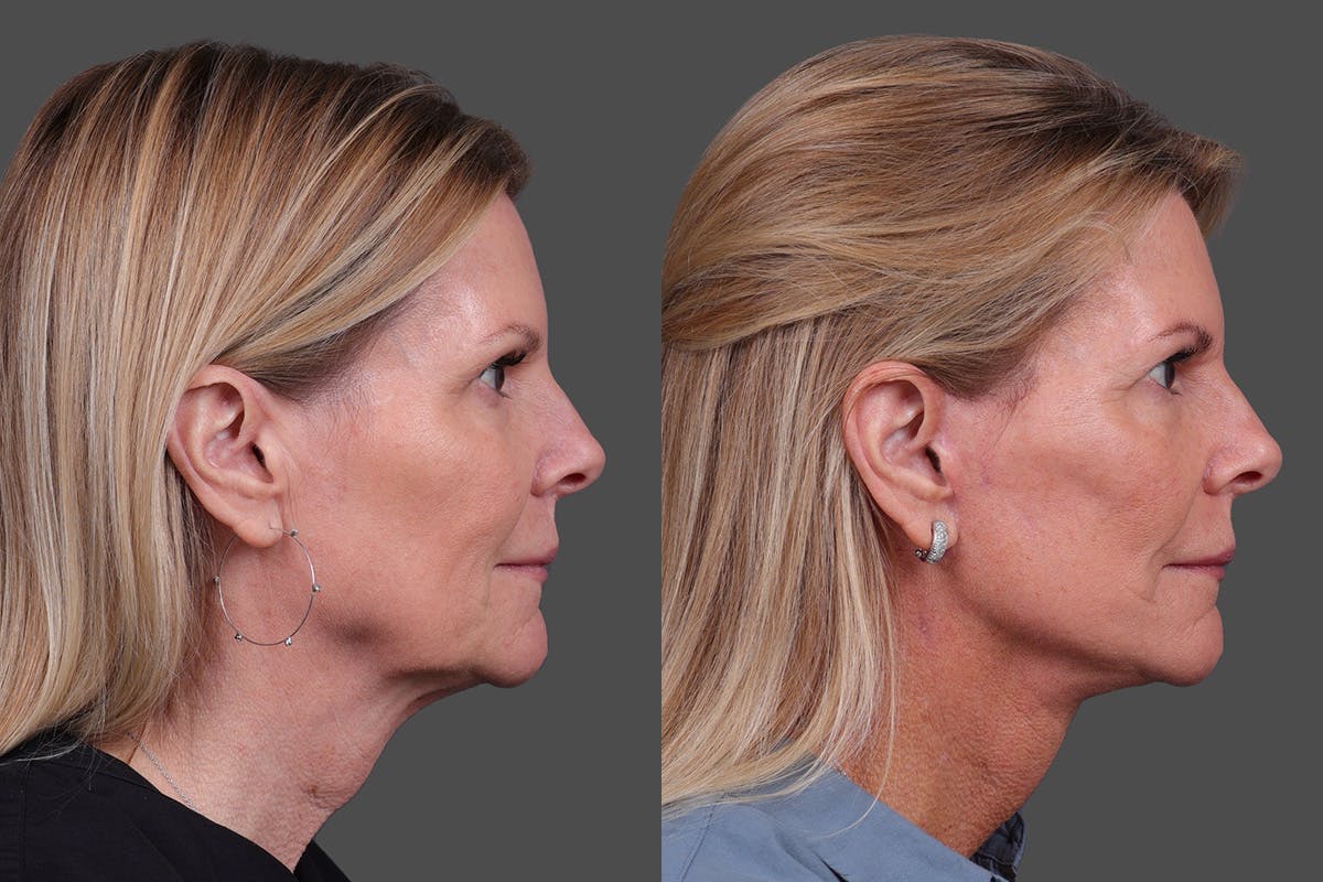 Facelift Before & After Gallery - Patient 310889 - Image 3