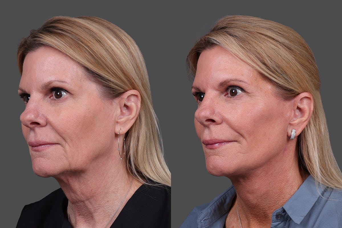 Facelift Before & After Gallery - Patient 310889 - Image 4