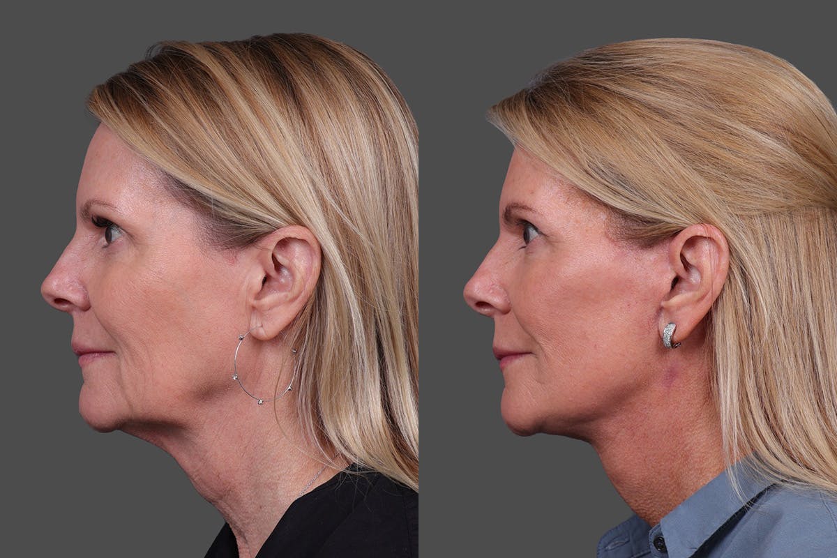 Facelift Before & After Gallery - Patient 310889 - Image 5