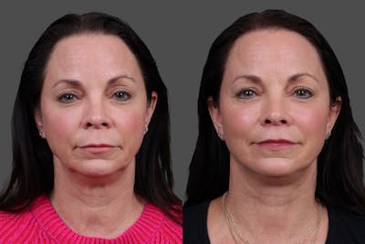 Facelift Before & After Gallery - Patient 357458 - Image 1