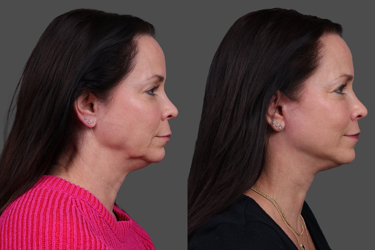Facelift Before & After Gallery - Patient 357458 - Image 3