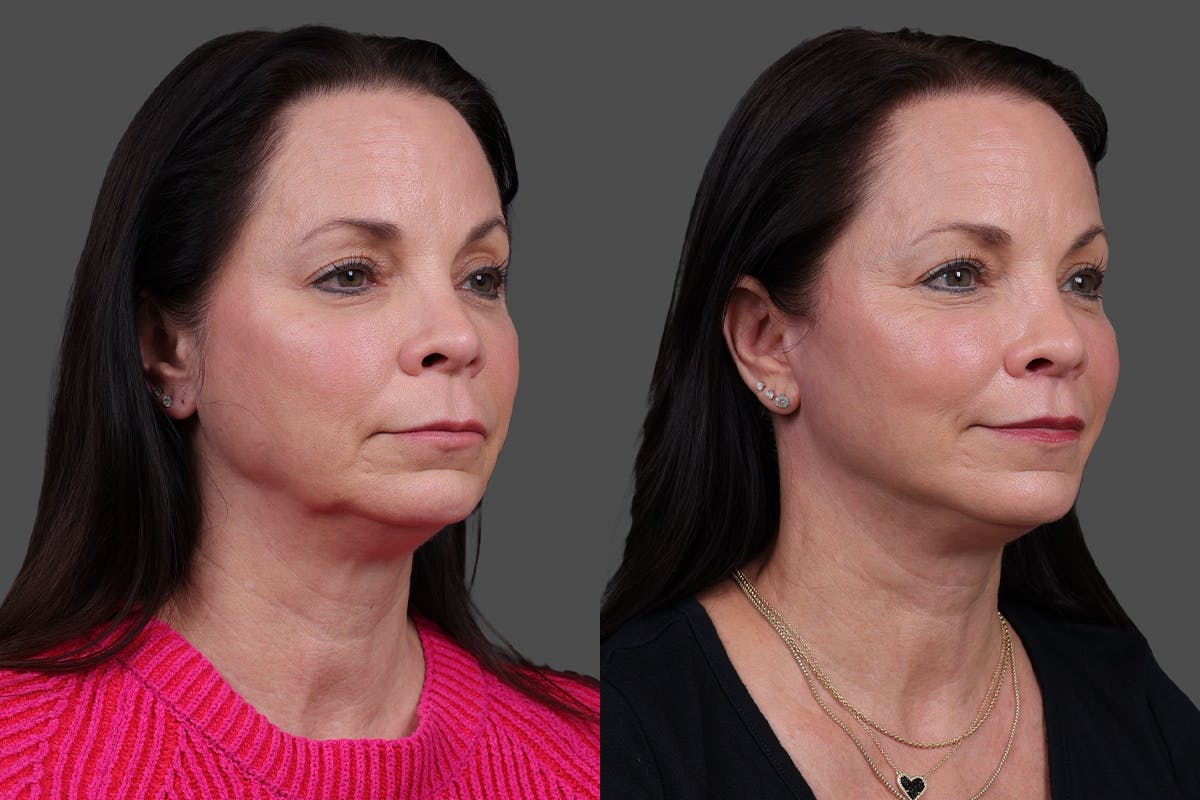 Facelift Before & After Gallery - Patient 357458 - Image 2