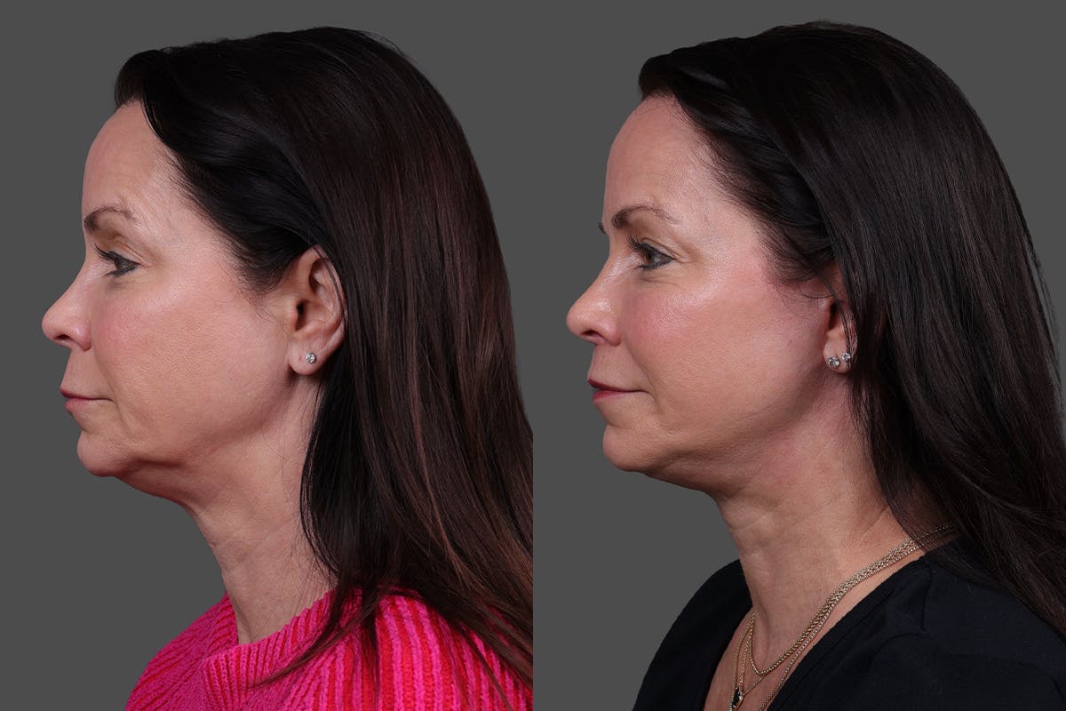 Facelift Before & After Gallery - Patient 357458 - Image 5