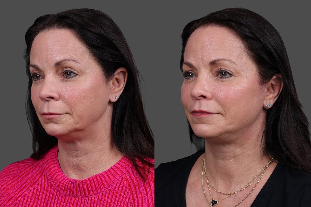 Facelift Before & After Gallery - Patient 357458 - Image 4