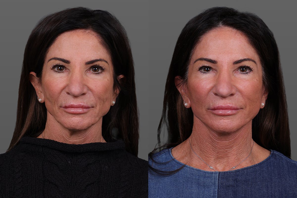 Limited Incision Facelift Before & After Gallery - Patient 399914 - Image 1