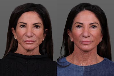 Limited Incision Facelift Before & After Gallery - Patient 399914 - Image 1