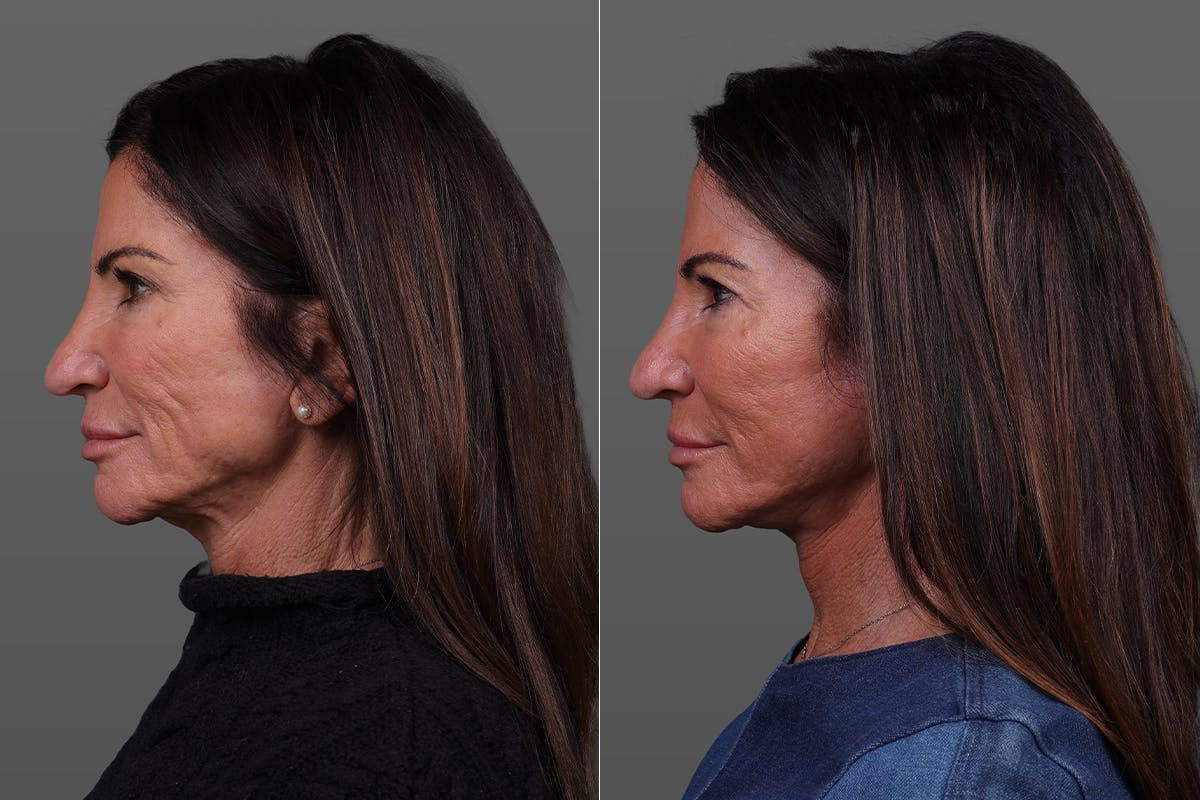 Limited Incision Facelift Before & After Gallery - Patient 399914 - Image 5