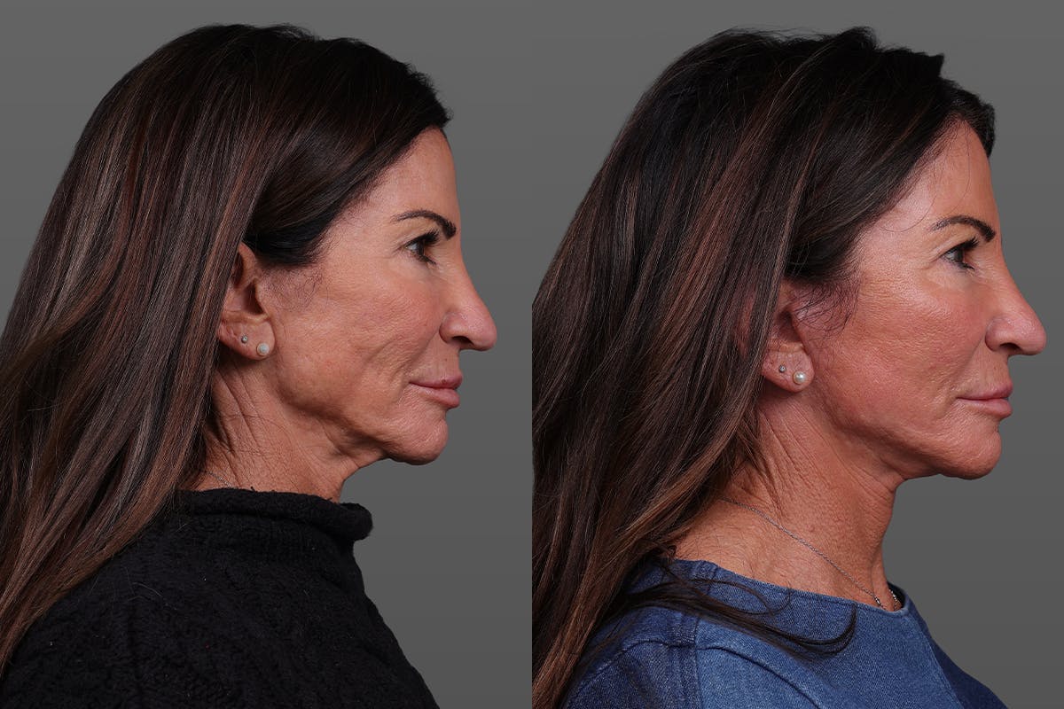 Limited Incision Facelift Before & After Gallery - Patient 399914 - Image 3