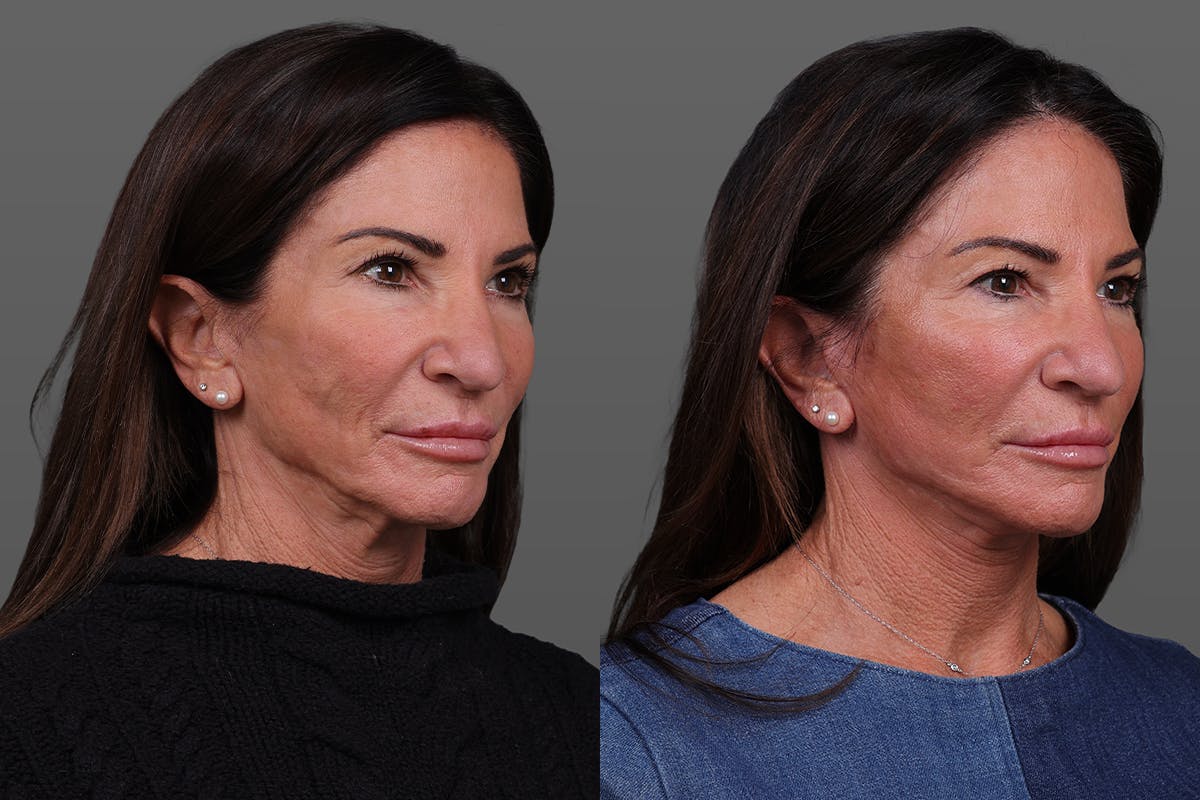 Limited Incision Facelift Before & After Gallery - Patient 399914 - Image 2