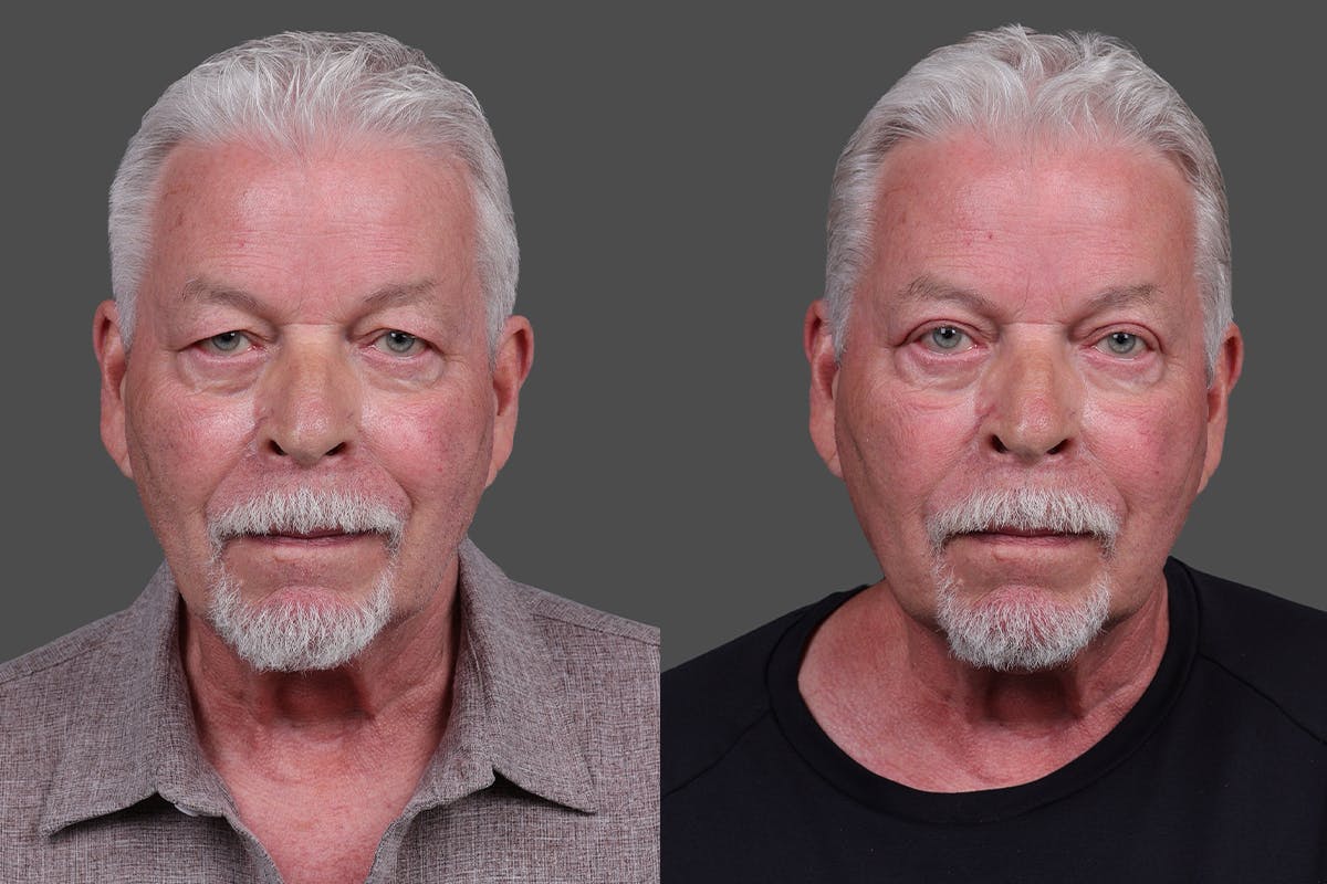 Eyelid Surgery (Blepharoplasty) Before & After Gallery - Patient 129882 - Image 1