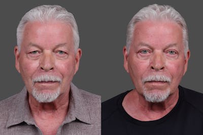Eyelid Surgery (Blepharoplasty) Before & After Gallery - Patient 129882 - Image 1