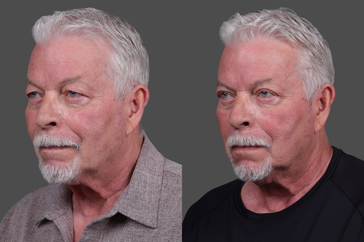 Eyelid Surgery (Blepharoplasty) Before & After Gallery - Patient 129882 - Image 3