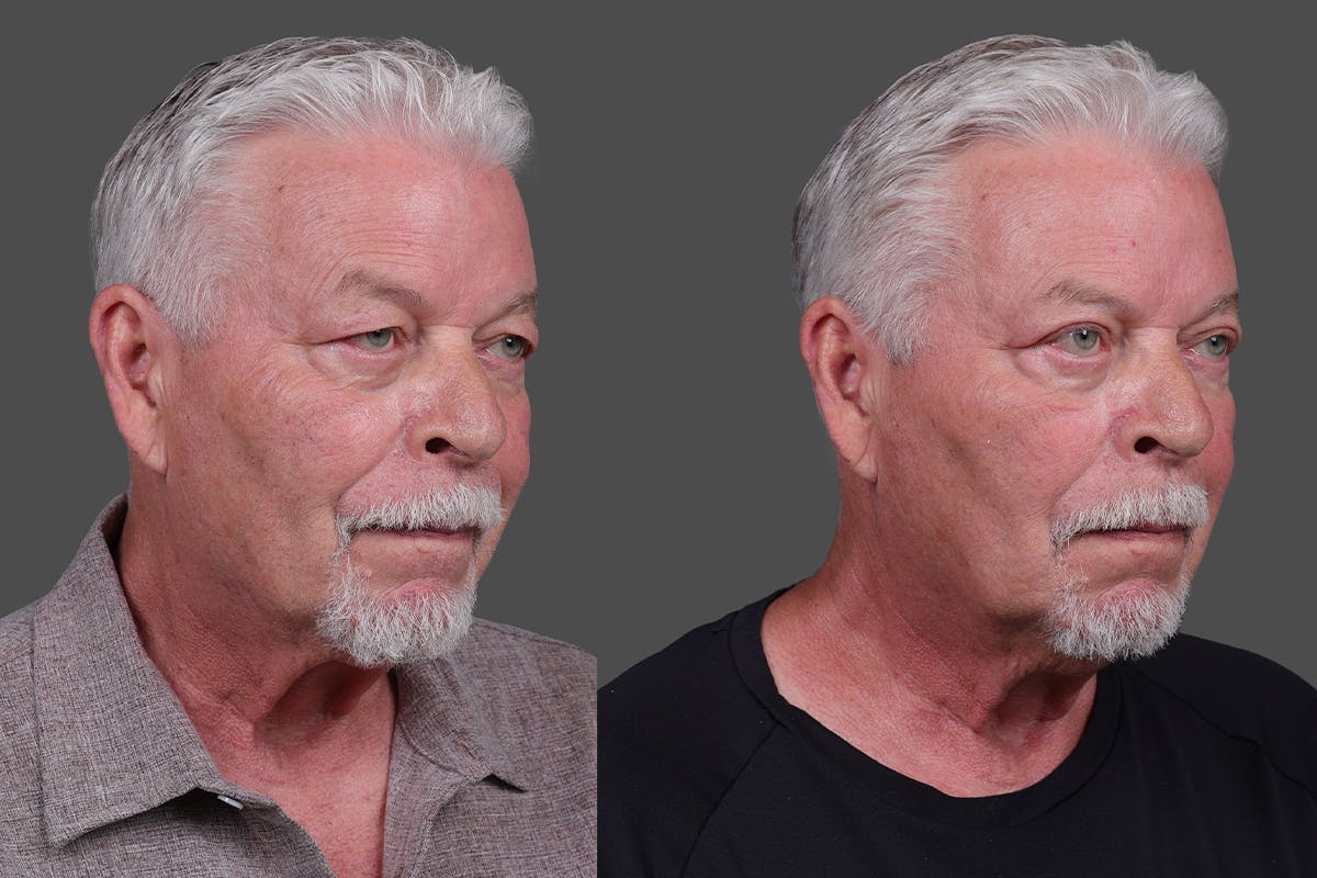 Eyelid Surgery (Blepharoplasty) Before & After Gallery - Patient 129882 - Image 2