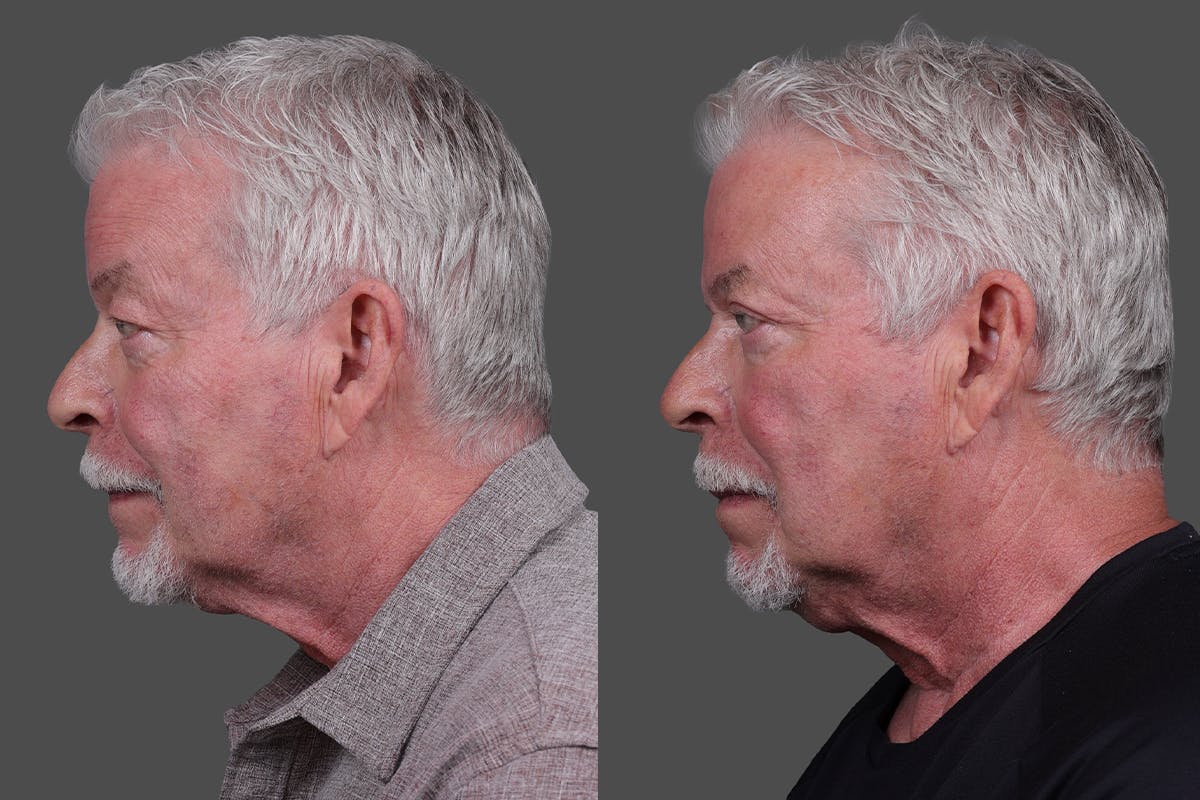 Eyelid Surgery (Blepharoplasty) Before & After Gallery - Patient 129882 - Image 4
