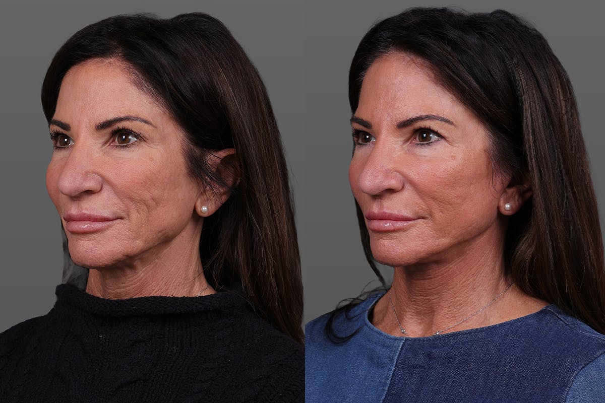 Limited Incision Facelift Before & After Gallery - Patient 399914 - Image 4
