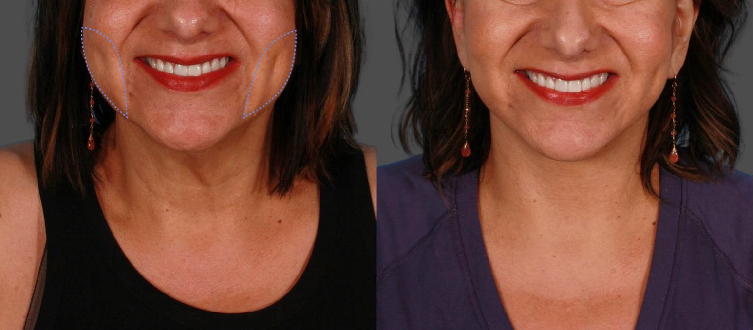 before and after buccal fat removal