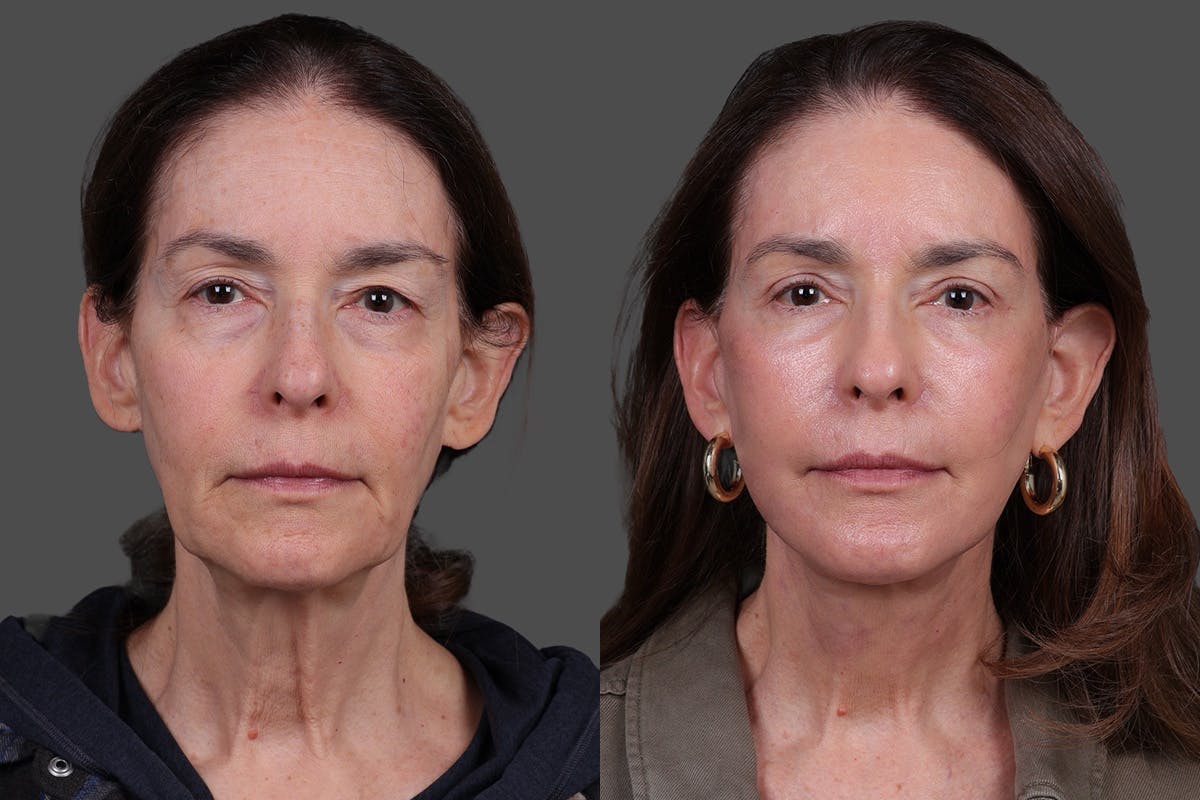 Eyelid Surgery (Blepharoplasty) Before & After Gallery - Patient 394656 - Image 1