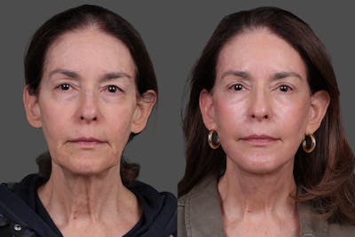 Eyelid Surgery (Blepharoplasty) Before & After Gallery - Patient 394656 - Image 1