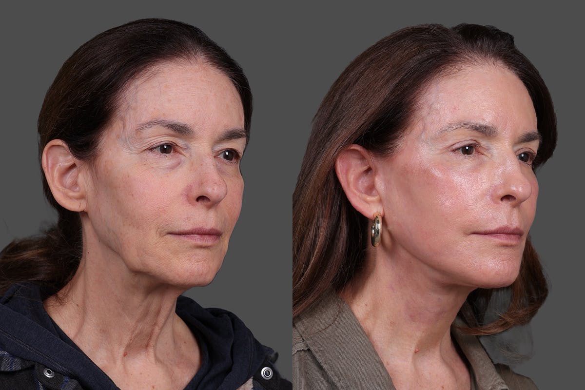 Eyelid Surgery (Blepharoplasty) Before & After Gallery - Patient 394656 - Image 2