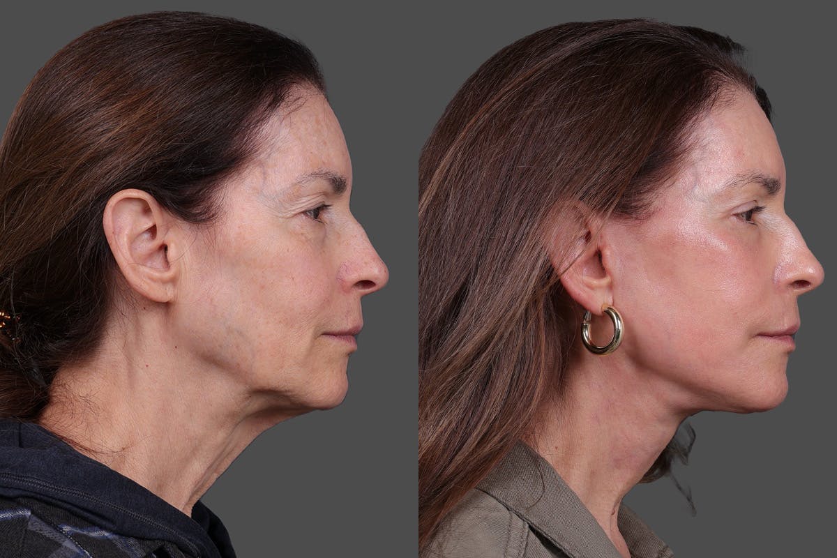 Eyelid Surgery (Blepharoplasty) Before & After Gallery - Patient 394656 - Image 3