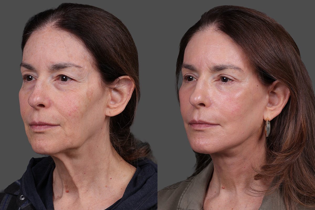 Eyelid Surgery (Blepharoplasty) Before & After Gallery - Patient 394656 - Image 4