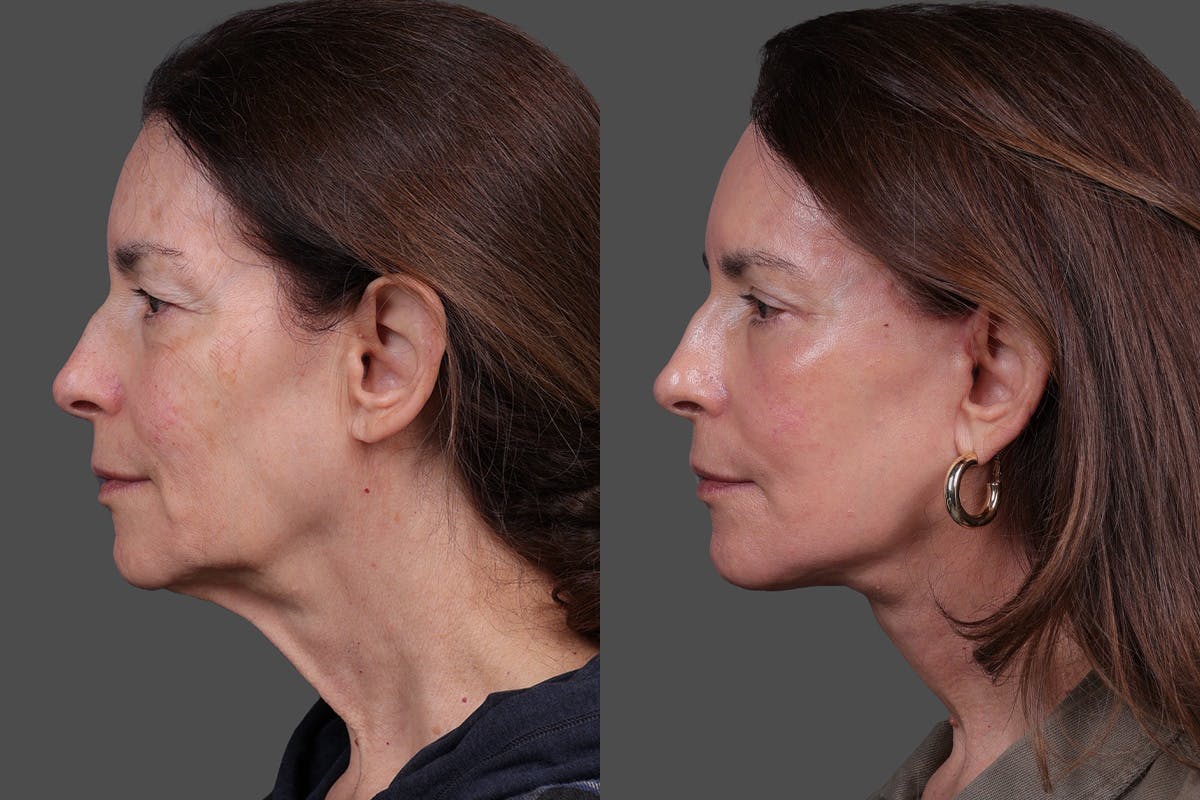 Eyelid Surgery (Blepharoplasty) Before & After Gallery - Patient 394656 - Image 5