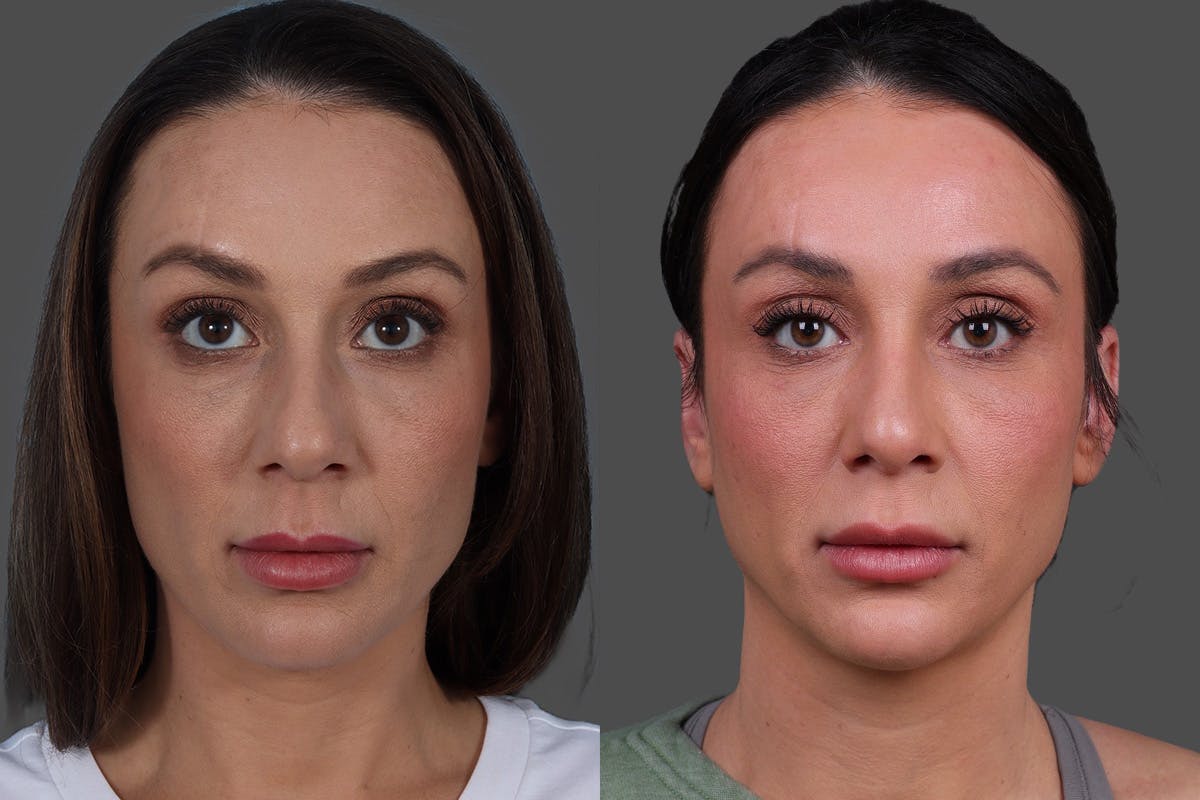 Rhinoplasty Before & After Gallery - Patient 243146 - Image 3