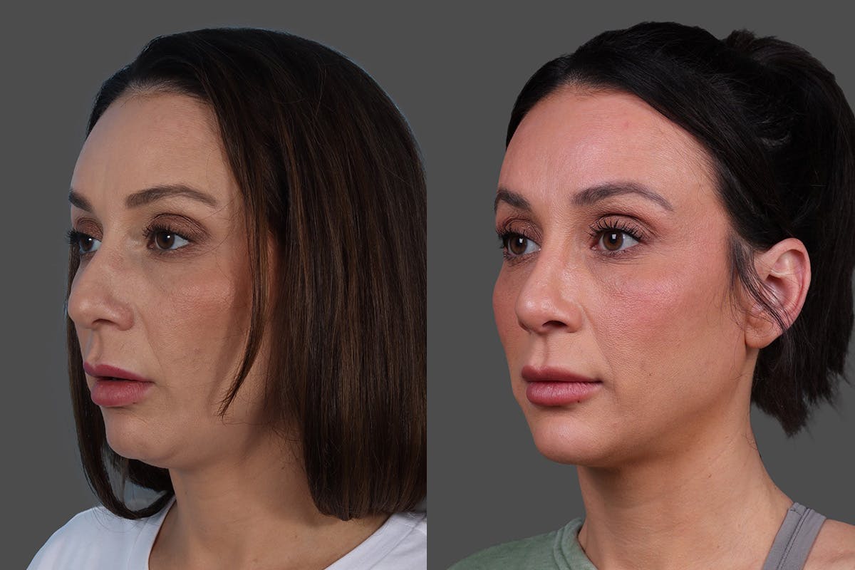 Rhinoplasty Before & After Gallery - Patient 243146 - Image 4