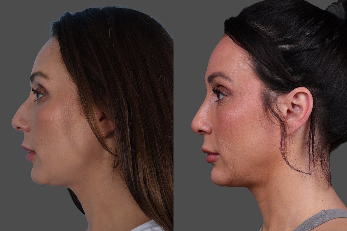 Rhinoplasty Before & After Gallery - Patient 243146 - Image 5