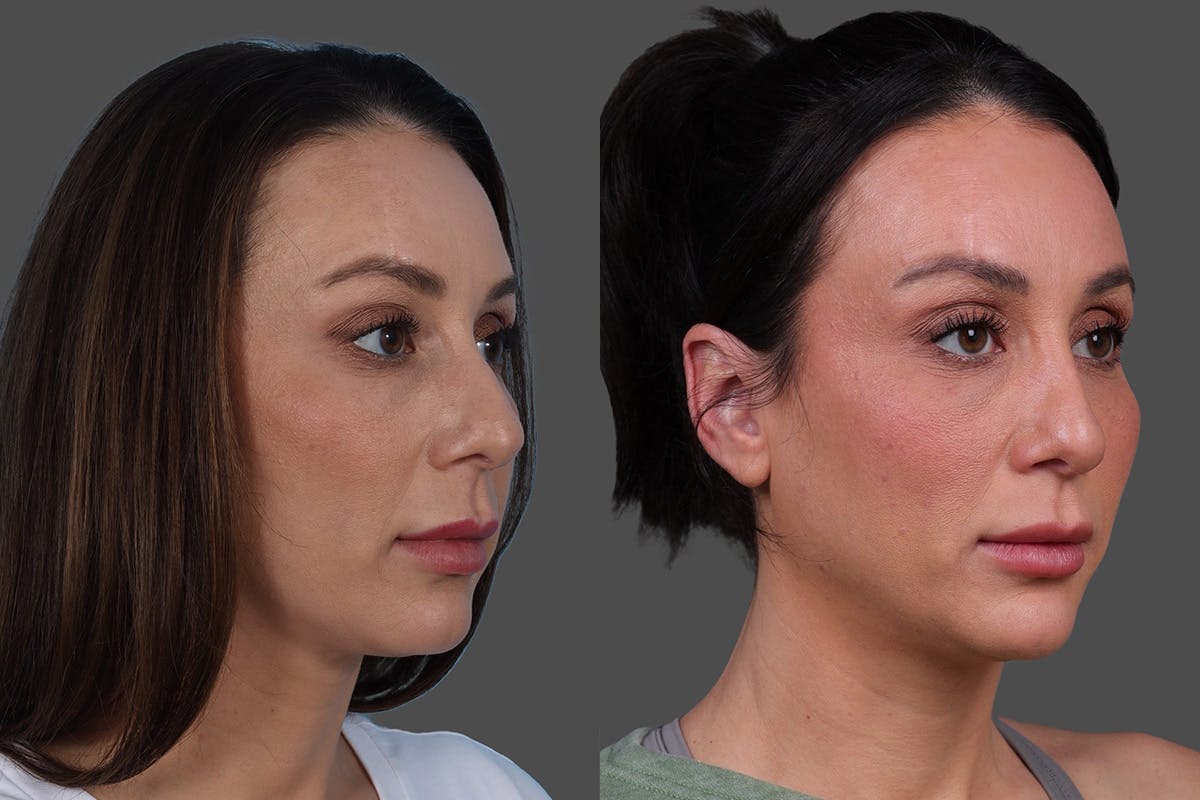 Rhinoplasty Before & After Gallery - Patient 243146 - Image 2