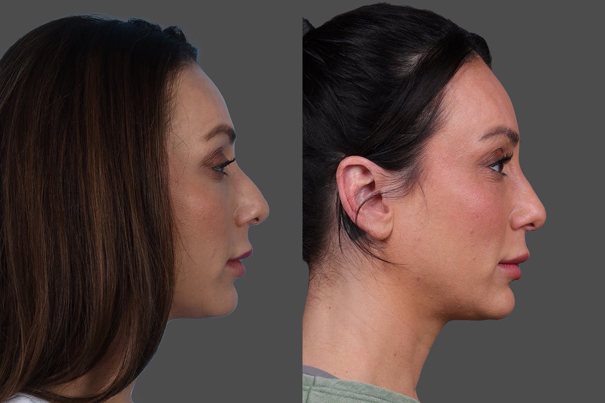 Rhinoplasty Before & After Gallery - Patient 243146 - Image 1