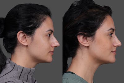 Rhinoplasty Before & After Gallery - Patient 100147 - Image 1