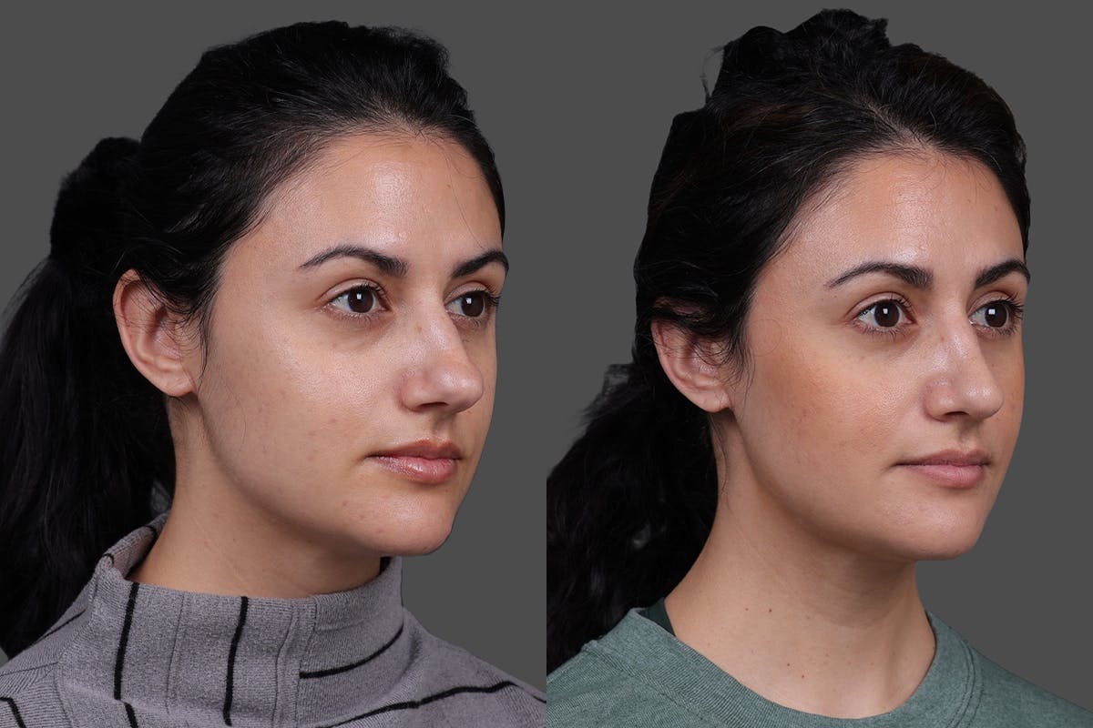 Rhinoplasty Before & After Gallery - Patient 100147 - Image 2