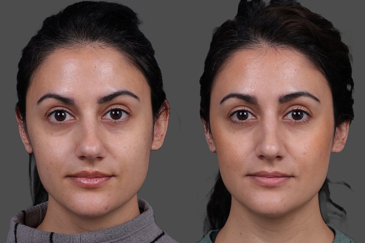 Rhinoplasty Before & After Gallery - Patient 100147 - Image 3