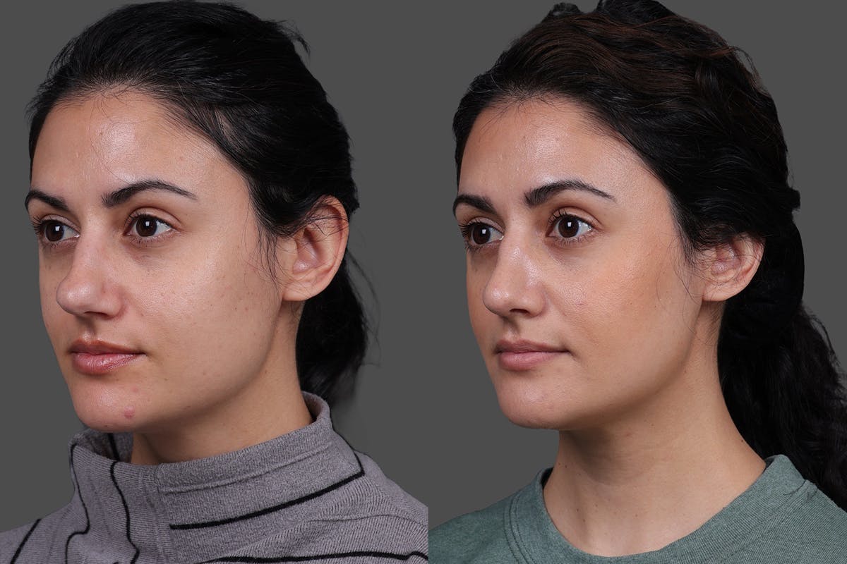Rhinoplasty Before & After Gallery - Patient 100147 - Image 4