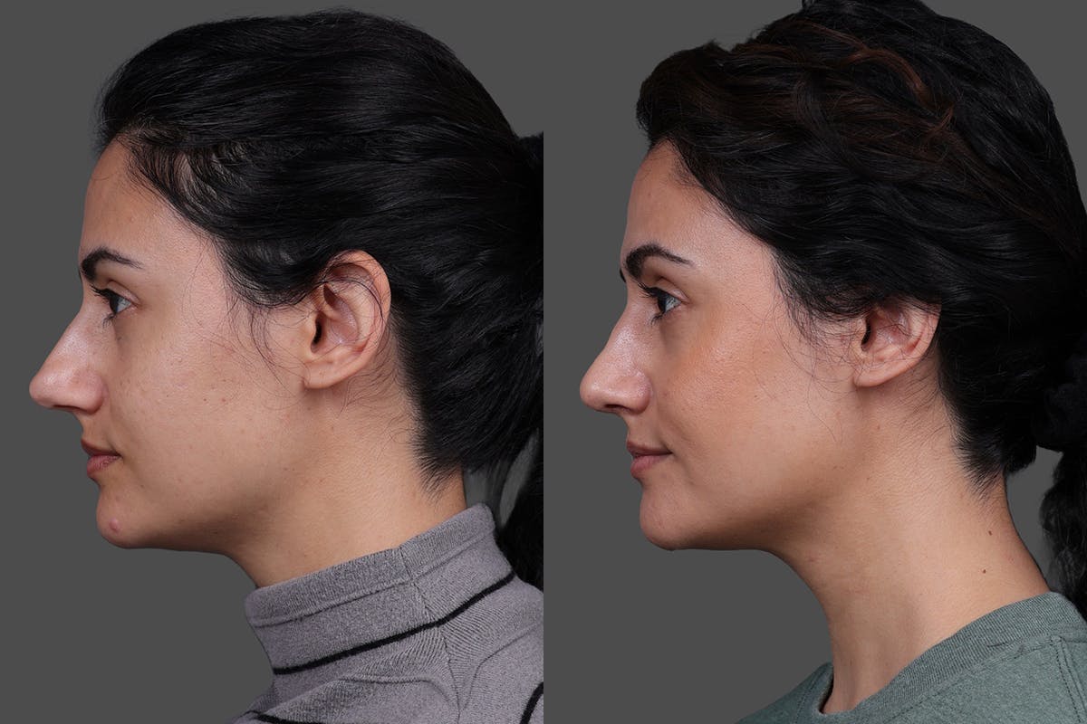 Rhinoplasty Before & After Gallery - Patient 100147 - Image 5