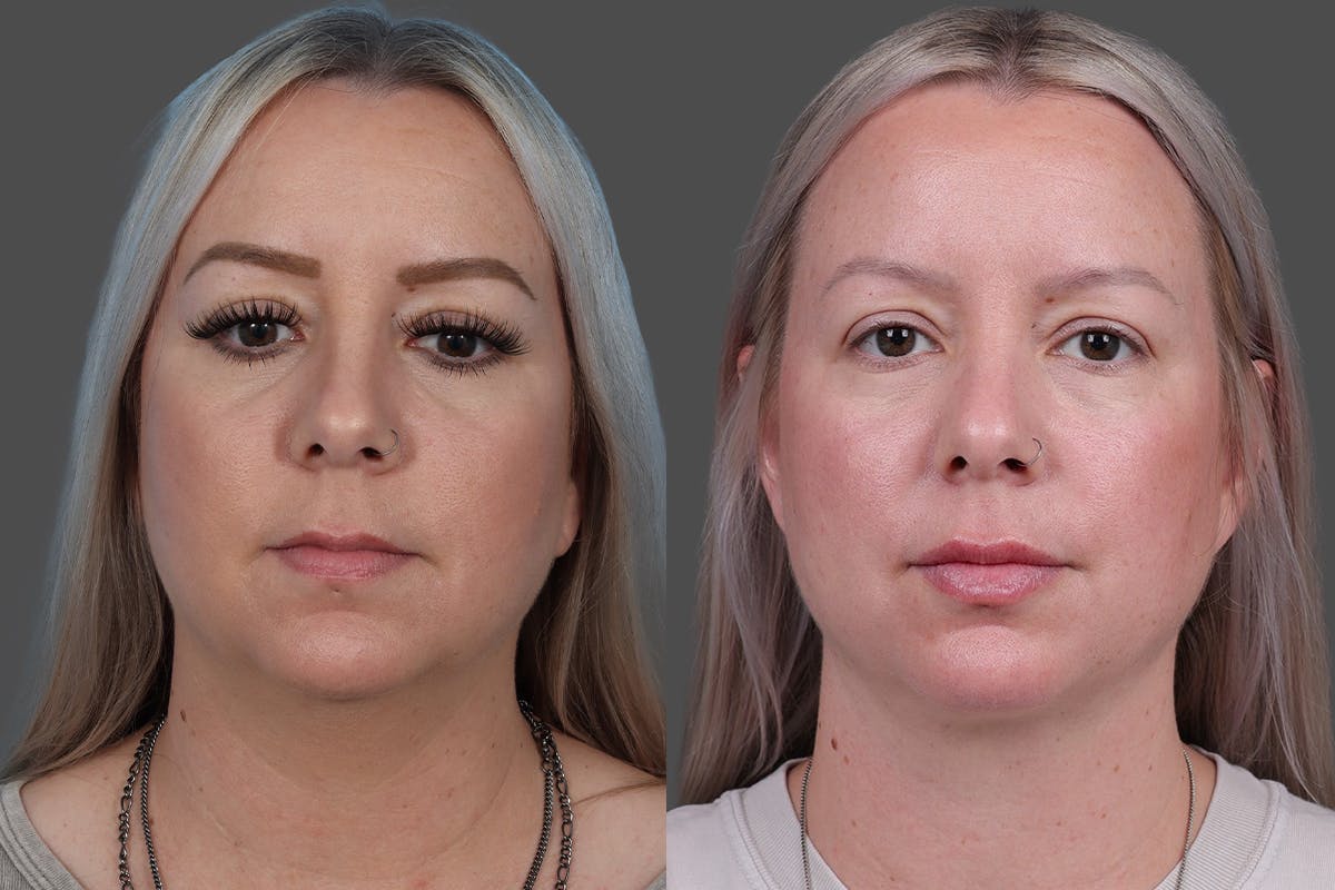 Neck Lift Before & After Gallery - Patient 776718 - Image 1