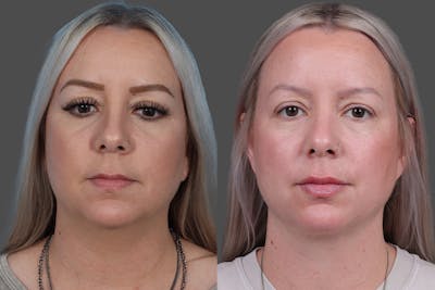 Neck Lift Before & After Gallery - Patient 776718 - Image 1