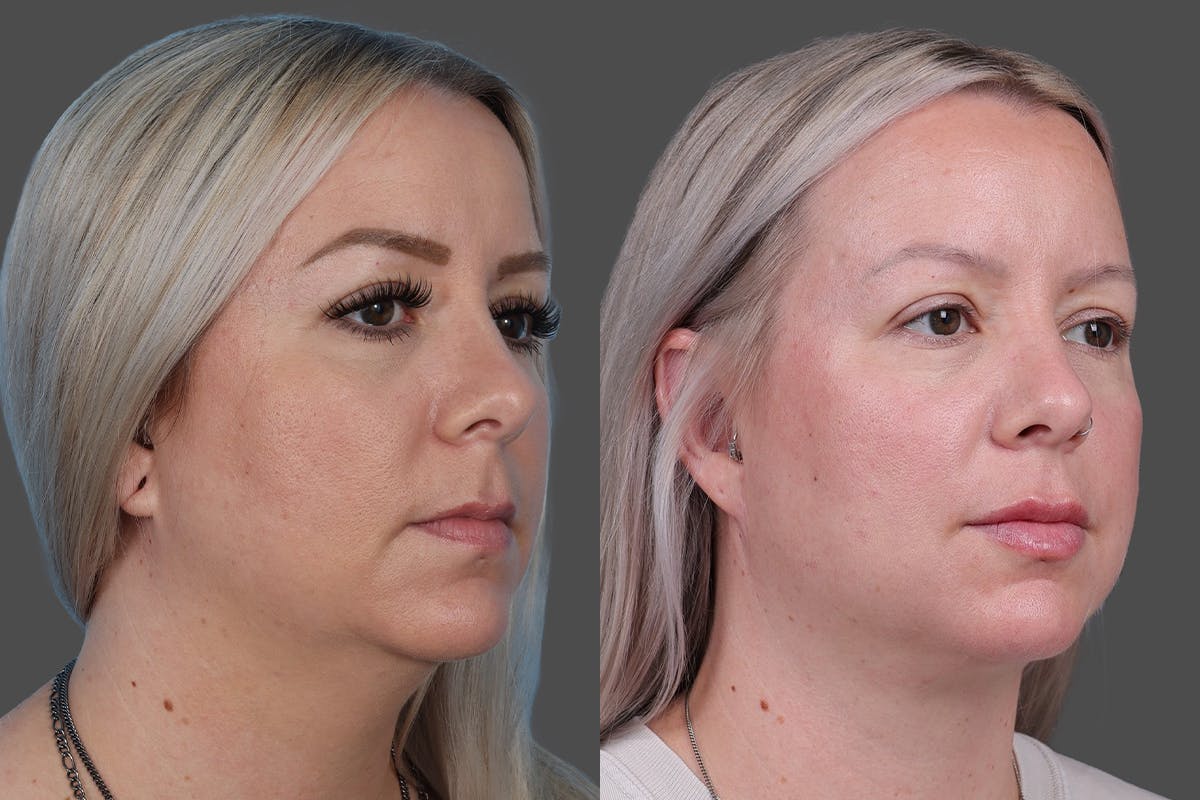 Neck Lift Before & After Gallery - Patient 776718 - Image 2