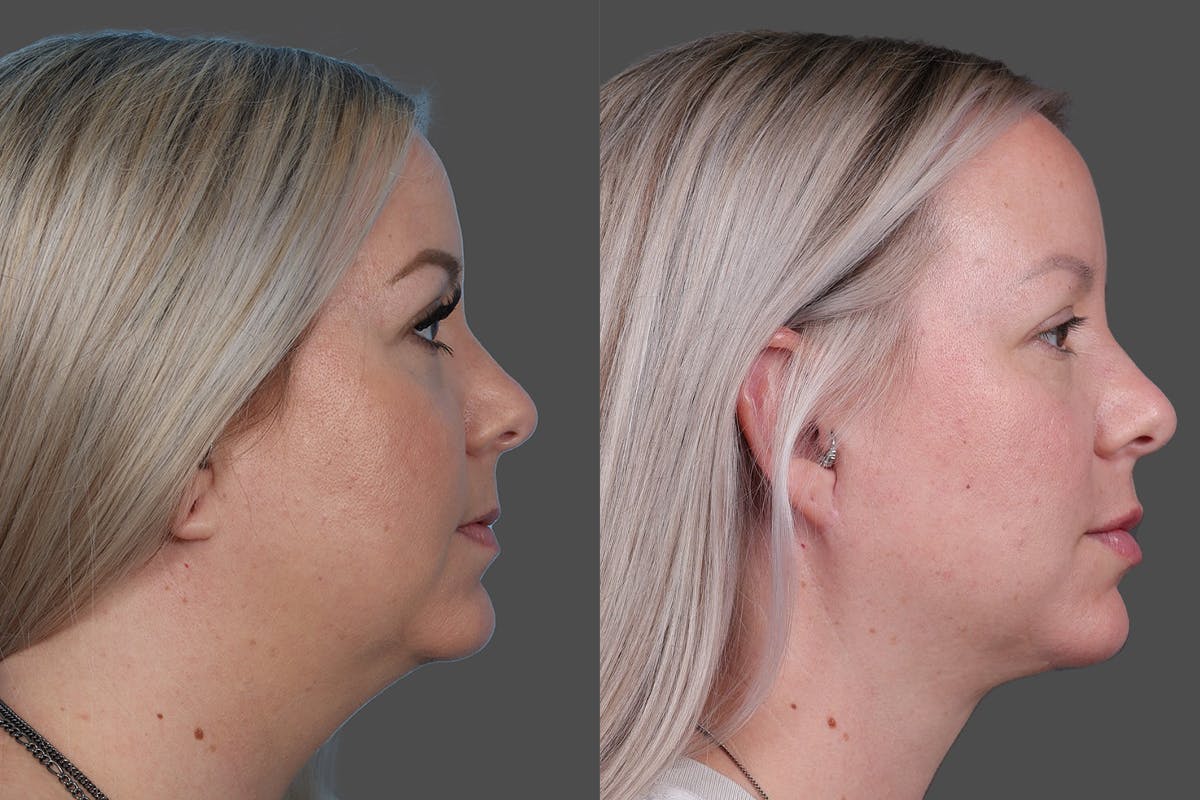 Neck Lift Before & After Gallery - Patient 776718 - Image 3