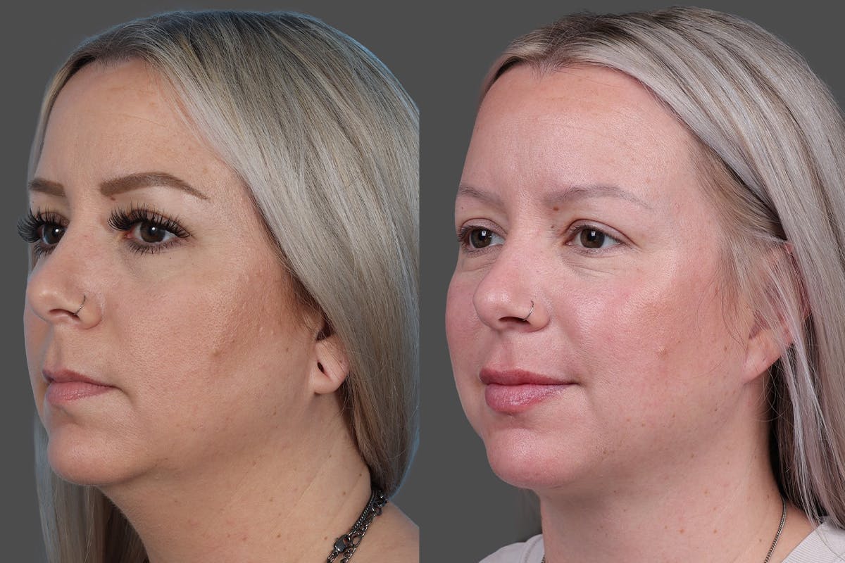 Neck Lift Before & After Gallery - Patient 776718 - Image 4