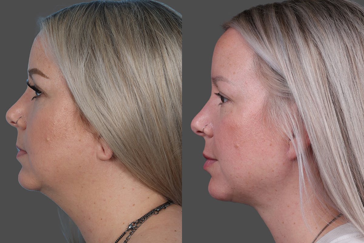 Neck Lift Before & After Gallery - Patient 776718 - Image 5