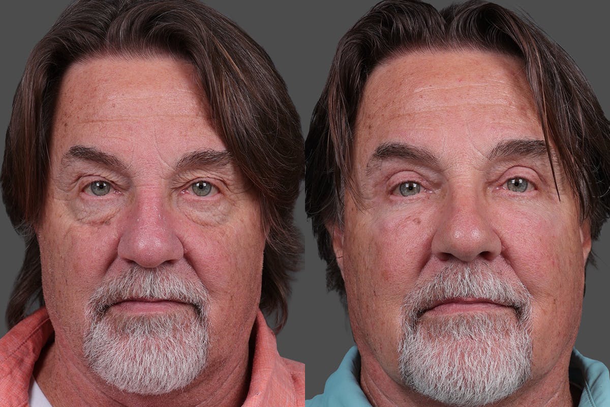 TCA Peel / Dermabrasion Before & After Gallery - Patient 277673 - Image 1