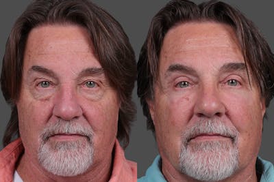 Eyelid Surgery (Blepharoplasty) Before & After Gallery - Patient 400793 - Image 1