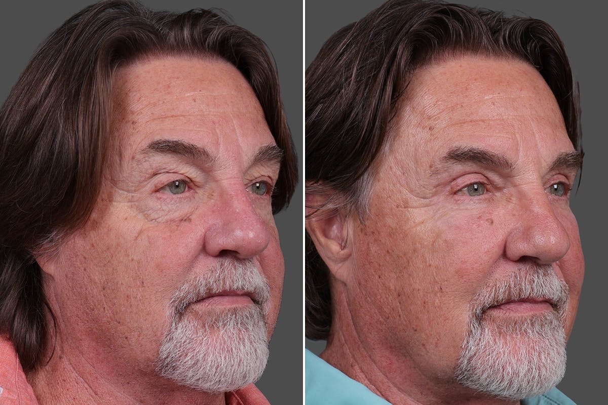TCA Peel / Dermabrasion Before & After Gallery - Patient 277673 - Image 2
