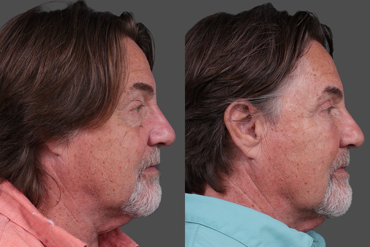 TCA Peel / Dermabrasion Before & After Gallery - Patient 277673 - Image 3