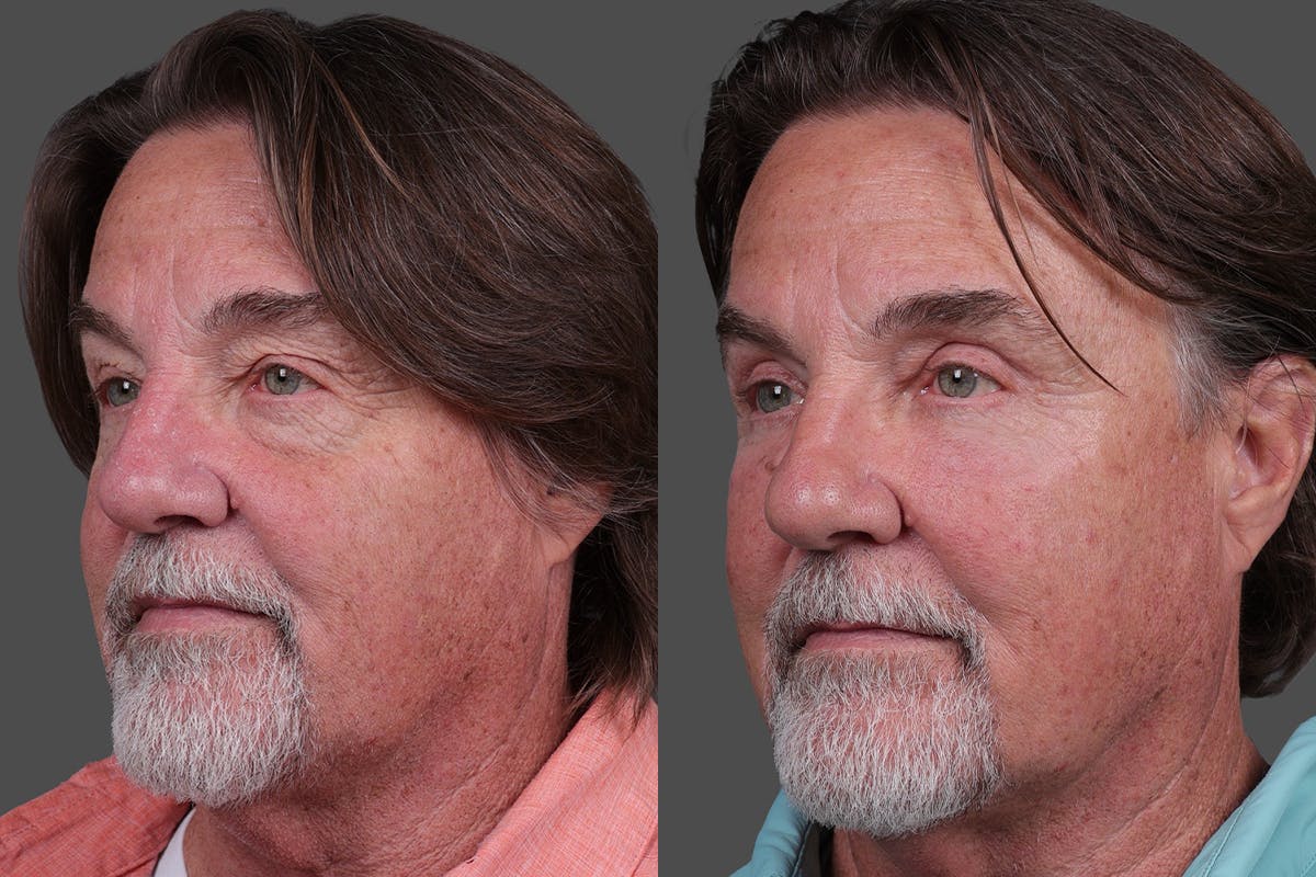 TCA Peel / Dermabrasion Before & After Gallery - Patient 277673 - Image 4