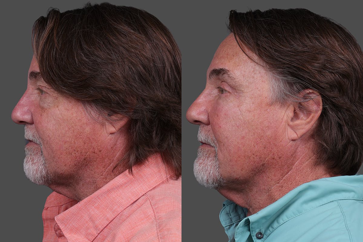 TCA Peel / Dermabrasion Before & After Gallery - Patient 277673 - Image 5