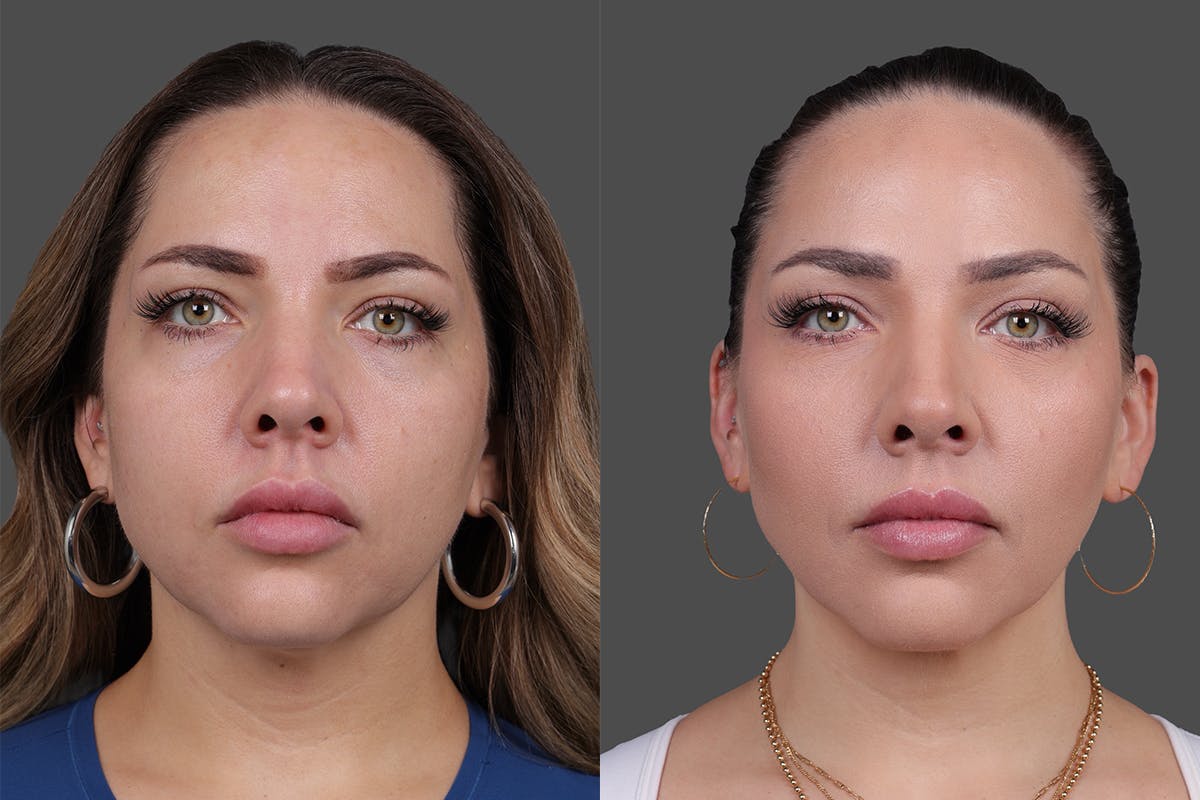 BOTOX® Before & After Gallery - Patient 102465 - Image 1