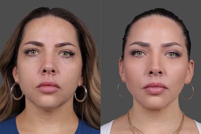 BOTOX® Before & After Gallery - Patient 102465 - Image 1